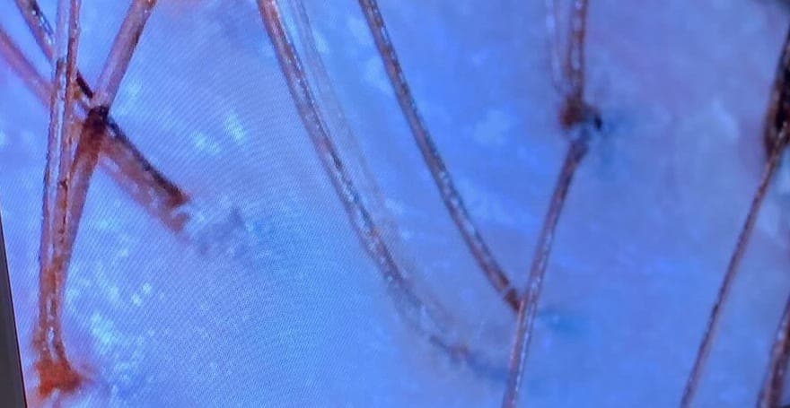 Detail vlasové pokožky před ošetřením z trichologické kamery